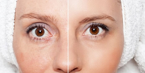 Microneedling Microneedling